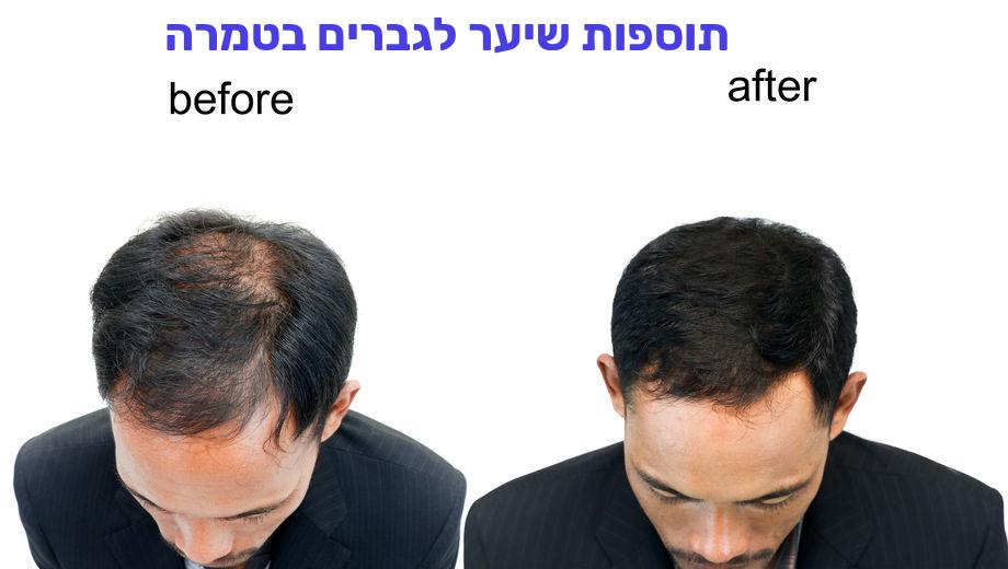 תוספות שיער לגברים בטמרה